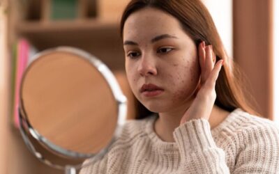 How Regular Facials Can Effectively Treat and Prevent Acne Breakouts