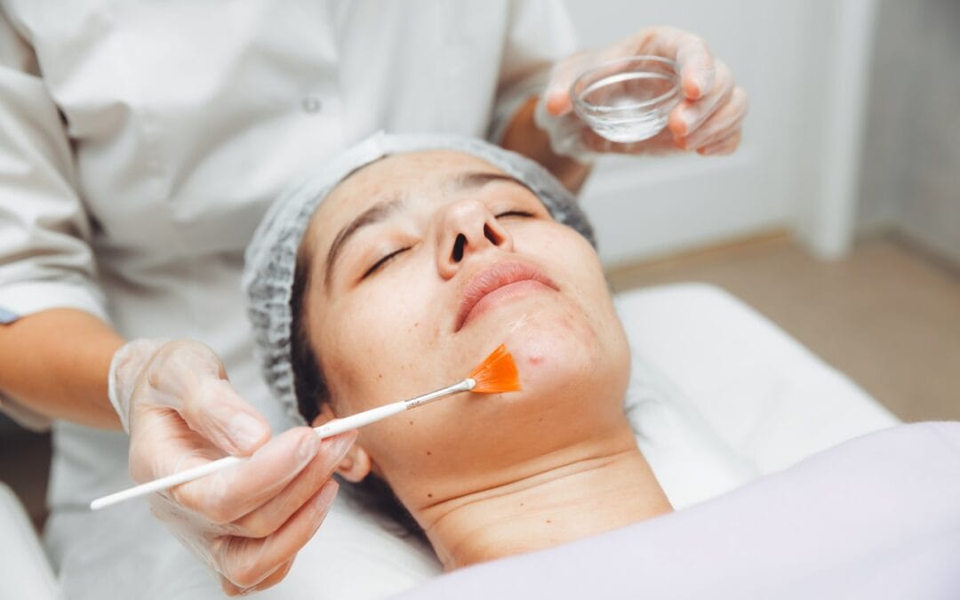 How Chemical Peels Improve Your Skin’s Appearance