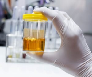 Urine Analysis